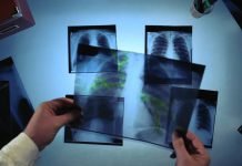 Тернівка лідирує на Дніпропетровщині за кількістю туберкульозників