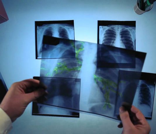 У Павлограді росте захворюваність на туберкульоз