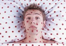 В Павлограде зафиксирована вспышка ветрянки