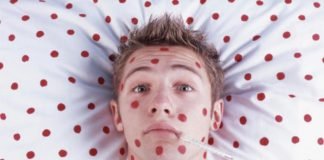 В Павлограде зафиксирована вспышка ветрянки