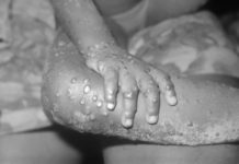 В світі реєструють все більше випадків мавпячої віспи: що це за хвороба