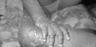В світі реєструють все більше випадків мавпячої віспи: що це за хвороба