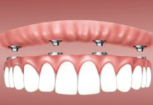 Все зубы на 4 имплантах: в чем особенность технологии и кому она подойдёт